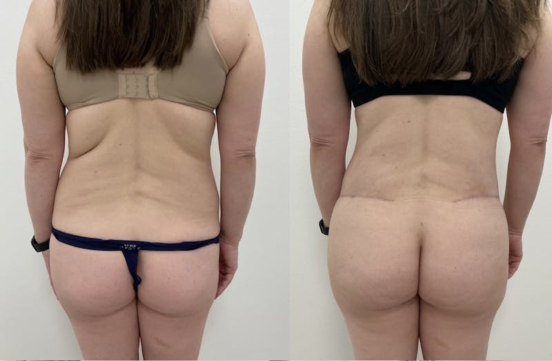 Flankplasty Before & After Gallery - Patient 753586 - Image 1