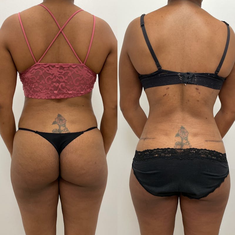 Flankplasty Before & After Gallery - Patient 148622 - Image 1