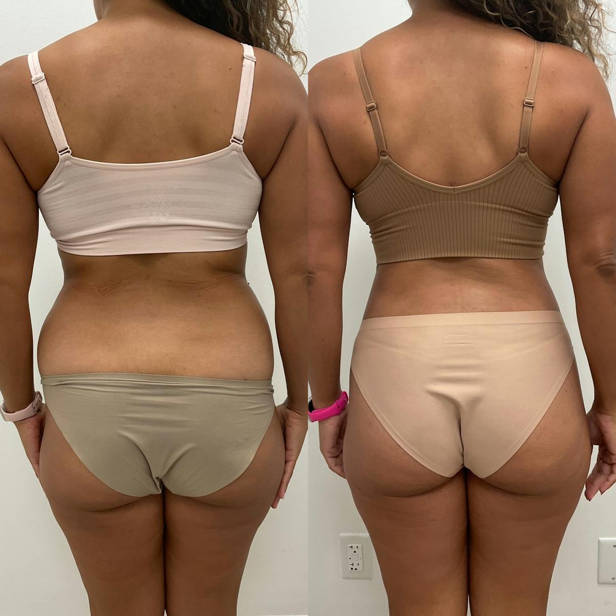 Flankplasty Before & After Gallery - Patient 325634 - Image 1