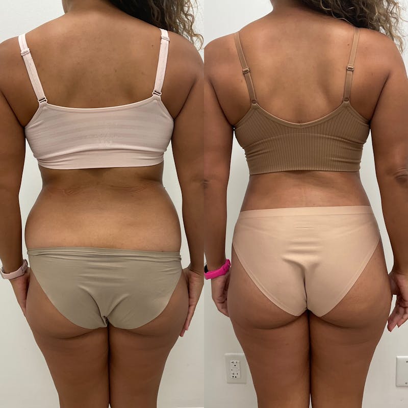 Flankplasty Before & After Gallery - Patient 325634 - Image 1