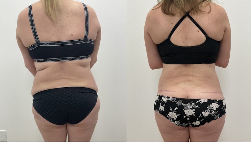 Flankplasty Before & After Gallery - Patient 108474 - Image 1