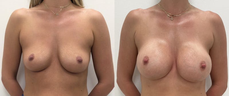 Breast Augmentation Before & After Gallery - Patient 897856 - Image 1