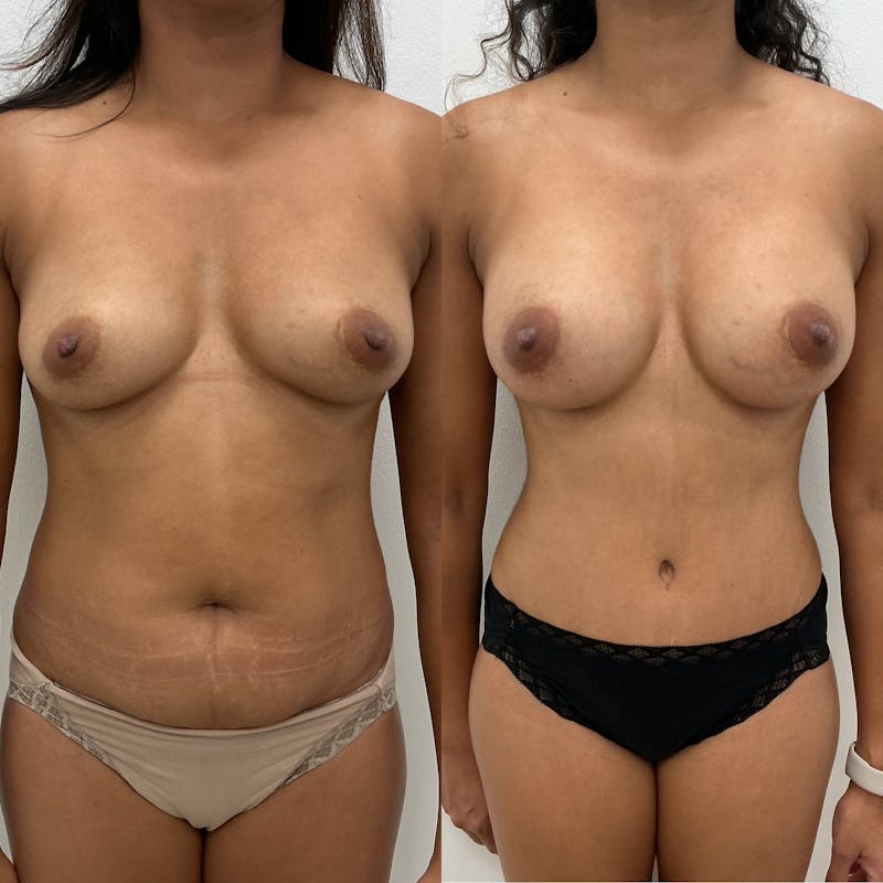 Breast Augmentation Before & After Gallery - Patient 822013 - Image 1