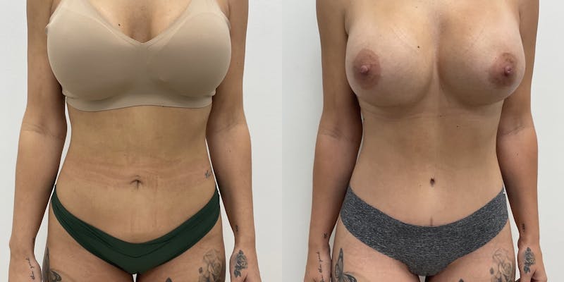 Breast Augmentation Before & After Gallery - Patient 295419 - Image 1