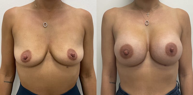 Breast Augmentation Before & After Gallery - Patient 751248 - Image 1