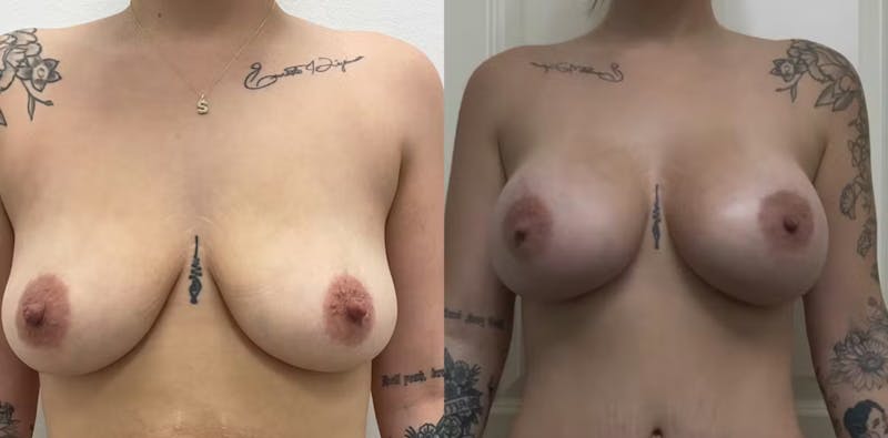 Breast Augmentation Before & After Gallery - Patient 392115 - Image 1