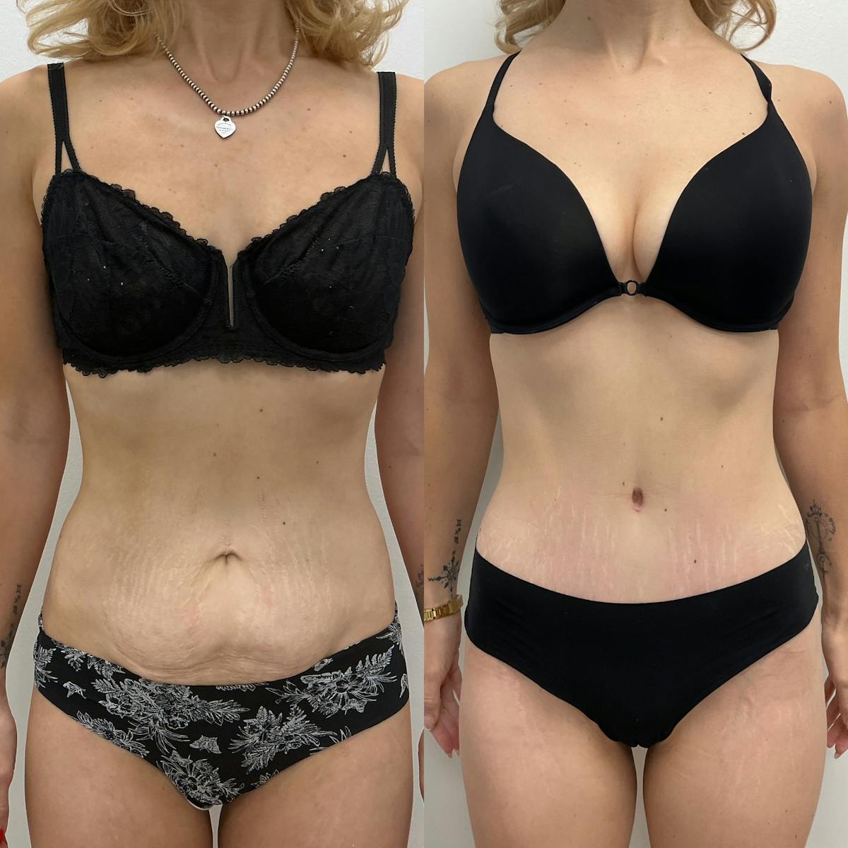 Tummy Tuck Before & After Gallery - Patient 178124 - Image 1