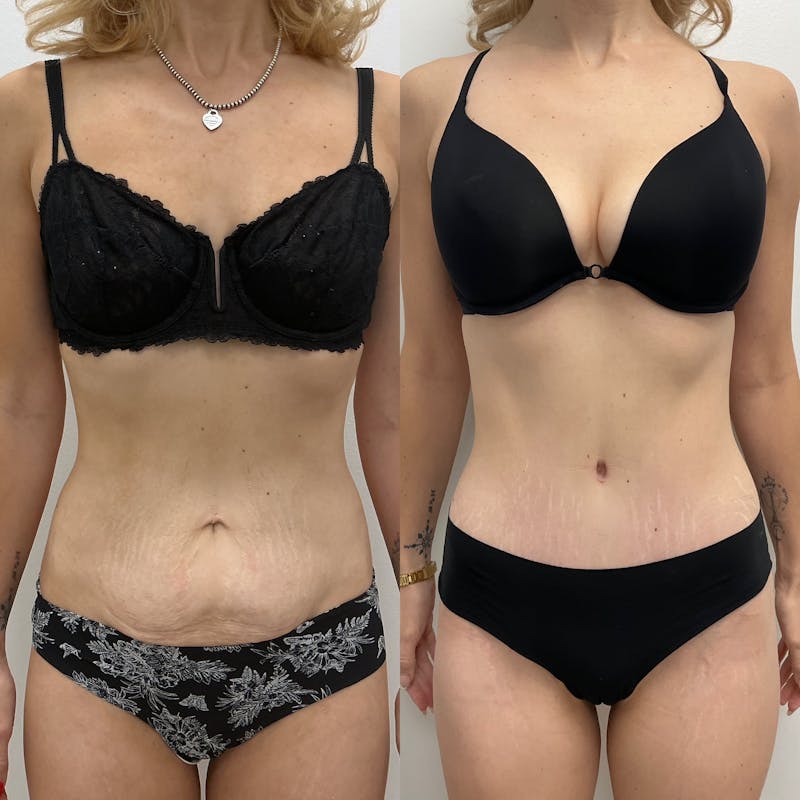 Tummy Tuck Before & After Gallery - Patient 178124 - Image 1