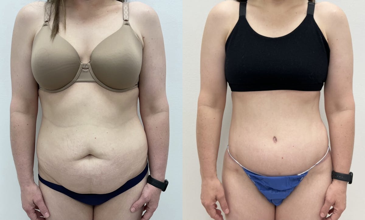 Tummy Tuck Before & After Gallery - Patient 379111 - Image 1