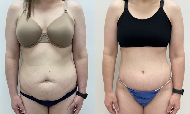 Tummy Tuck Before & After Gallery - Patient 379111 - Image 1