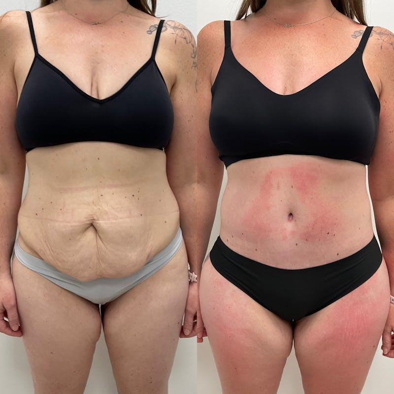 Tummy Tuck Before & After Gallery - Patient 901767 - Image 1