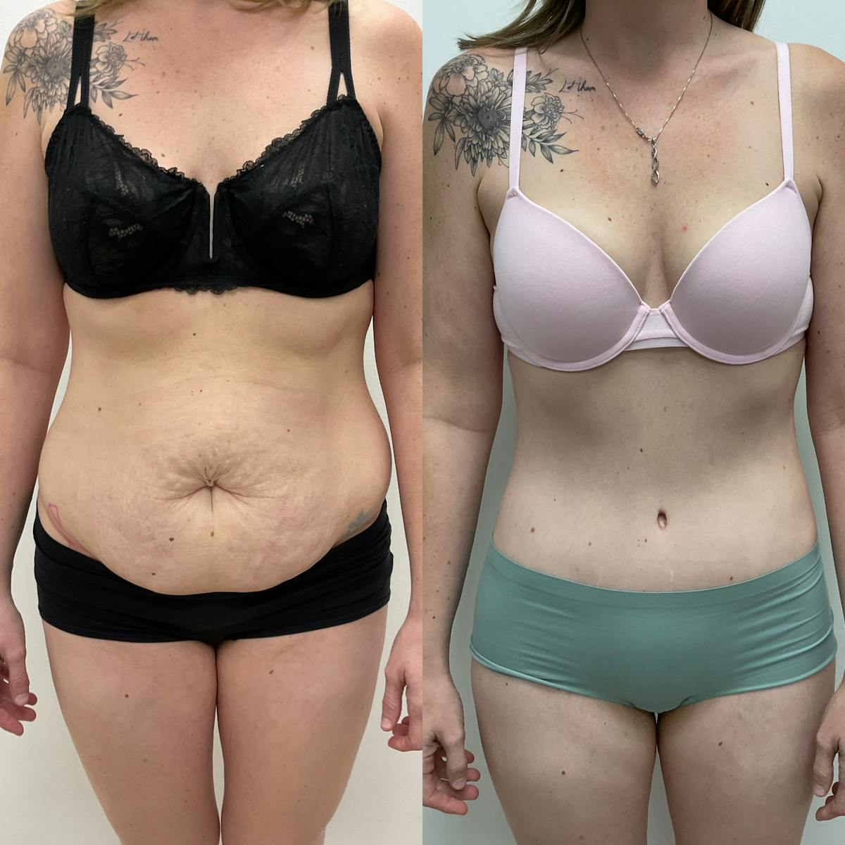 Tummy Tuck Before & After Gallery - Patient 285637 - Image 1
