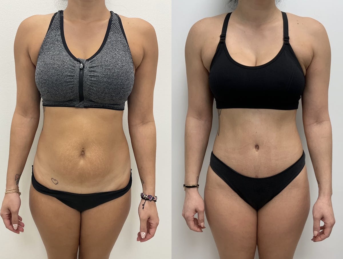 Tummy Tuck Before & After Gallery - Patient 334346 - Image 1