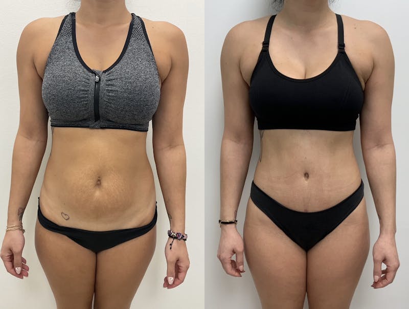 Tummy Tuck Before & After Gallery - Patient 334346 - Image 1