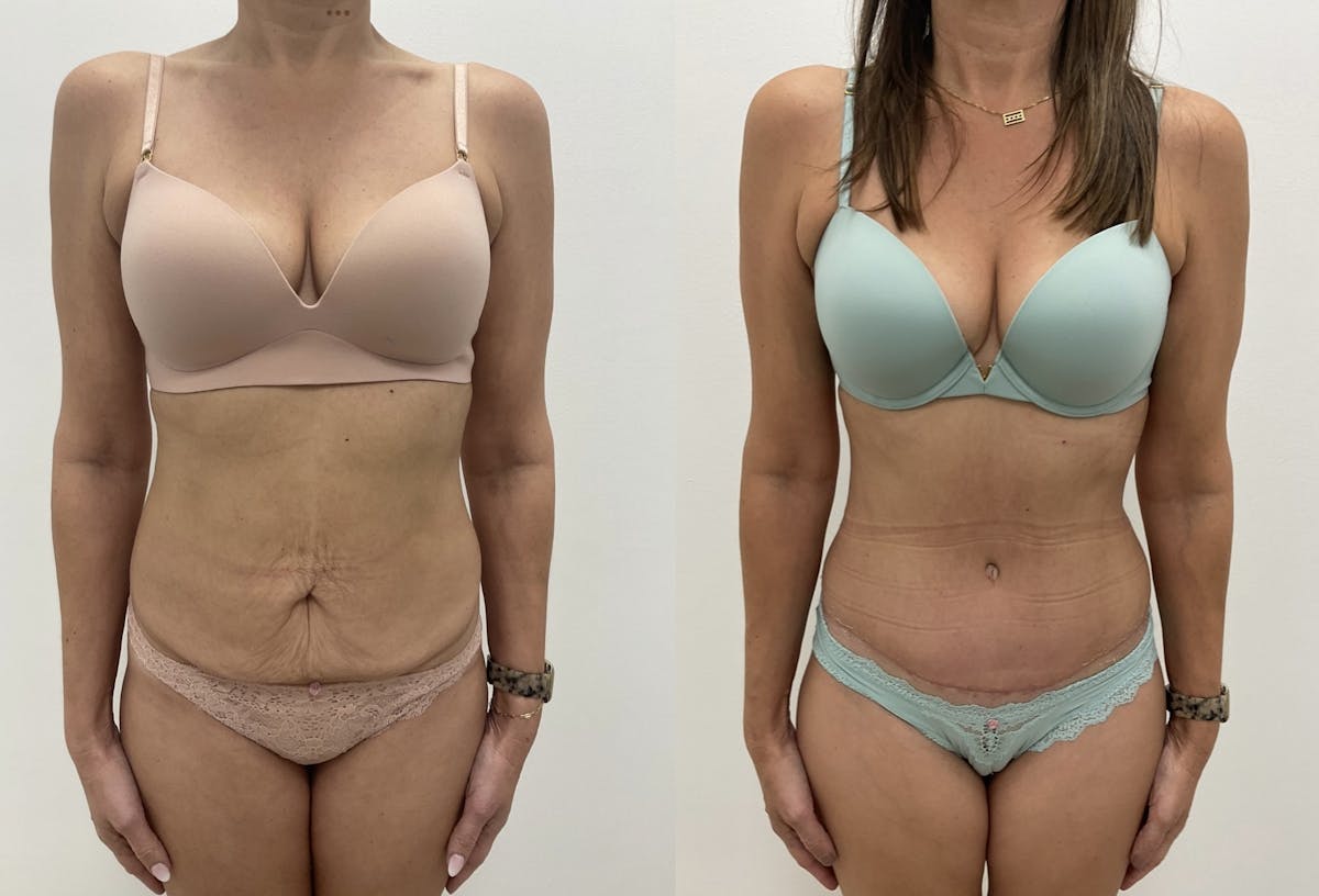 Tummy Tuck Before & After Gallery - Patient 195890 - Image 1