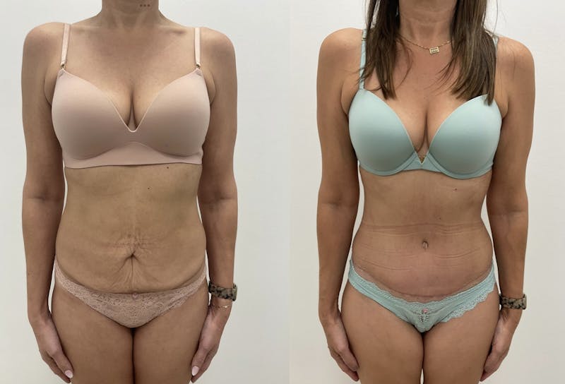 Tummy Tuck Before & After Gallery - Patient 195890 - Image 1