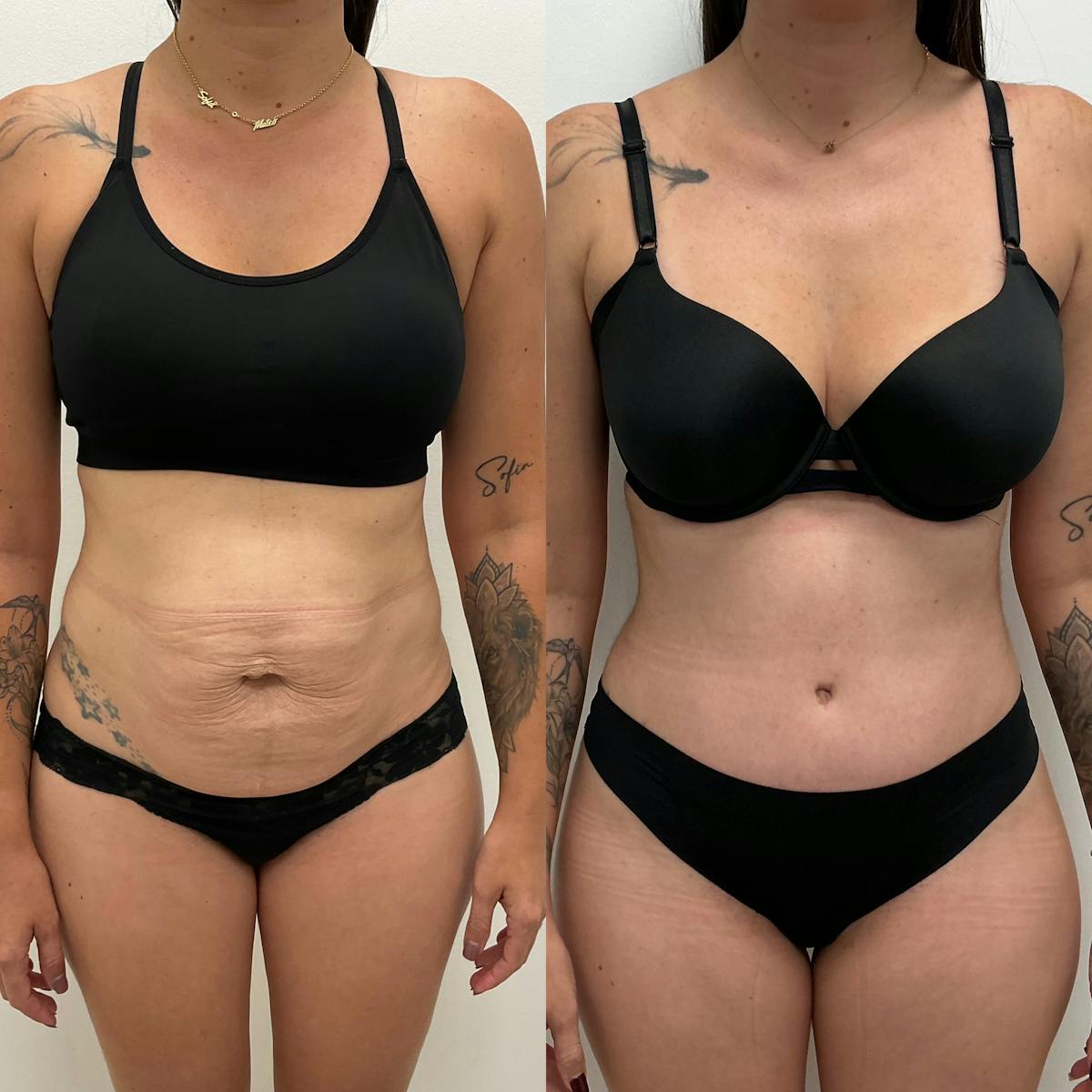 Tummy Tuck Before & After Gallery - Patient 548743 - Image 1