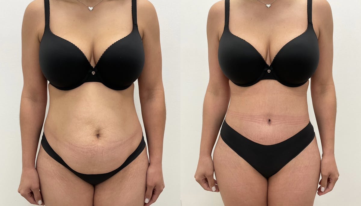 Tummy Tuck Before & After Gallery - Patient 432791 - Image 1