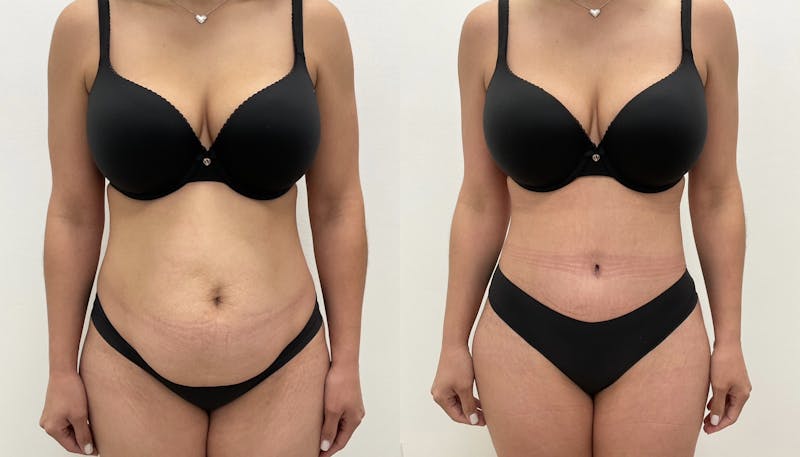 Tummy Tuck Before & After Gallery - Patient 432791 - Image 1