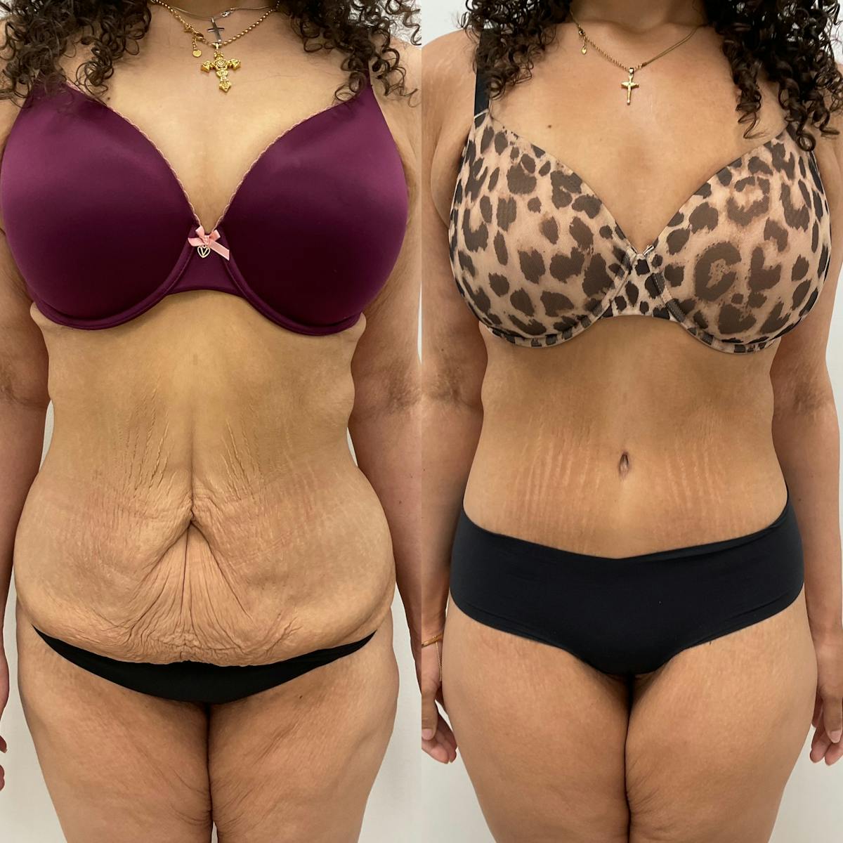 Tummy Tuck Before & After Gallery - Patient 119372 - Image 1