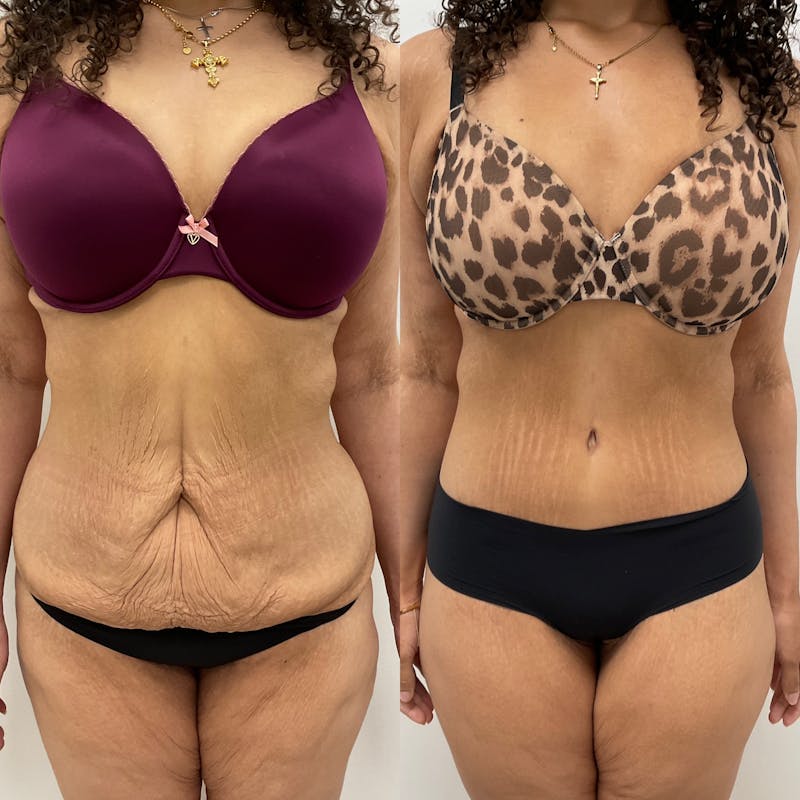 Tummy Tuck Before & After Gallery - Patient 119372 - Image 1
