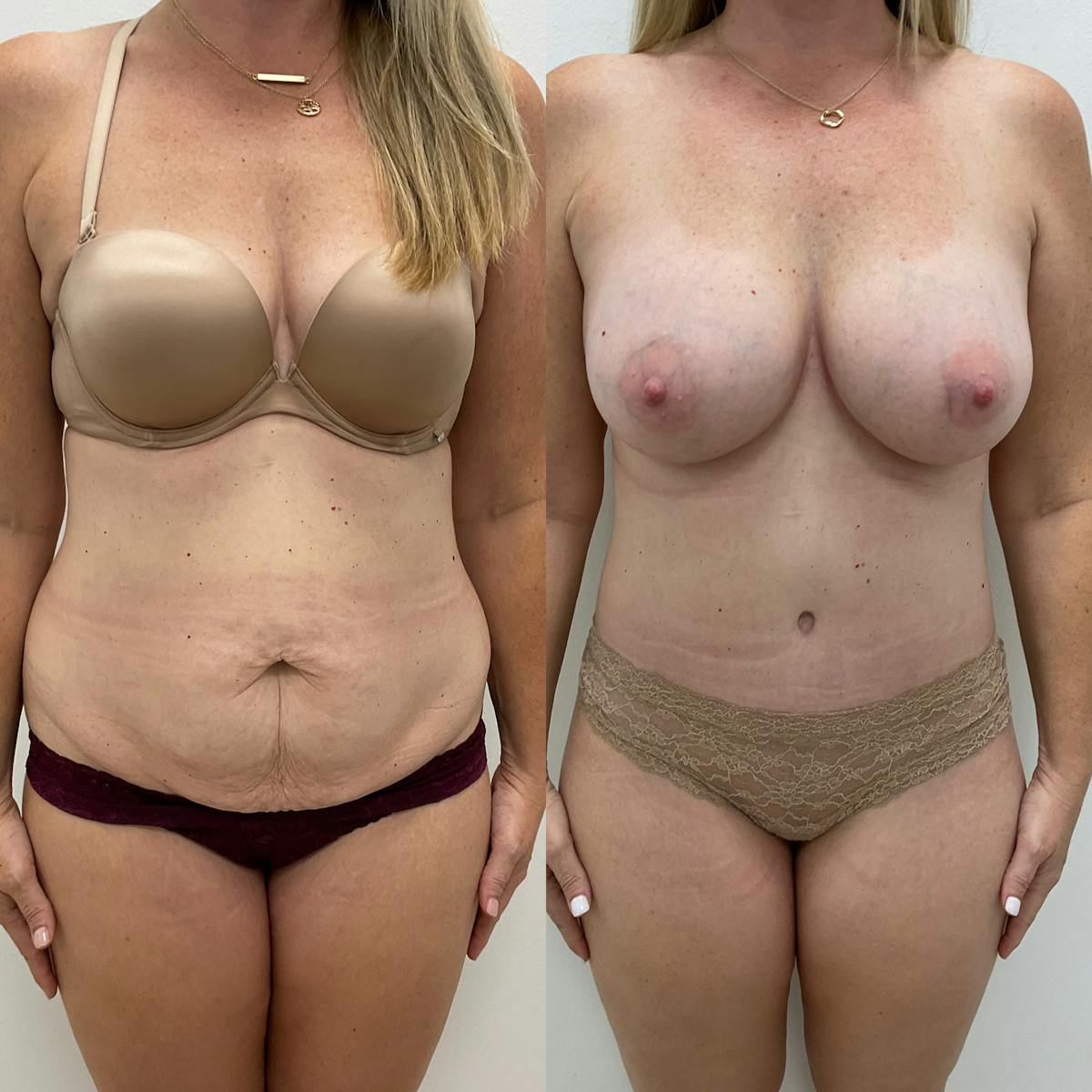 Tummy Tuck Before & After Gallery - Patient 123202 - Image 1