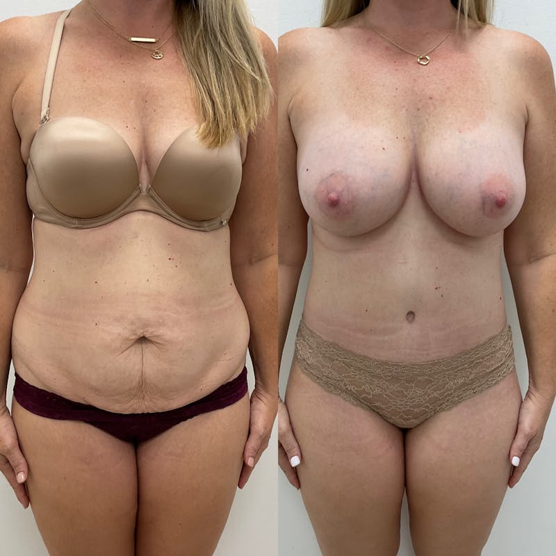 Tummy Tuck Before & After Gallery - Patient 123202 - Image 1