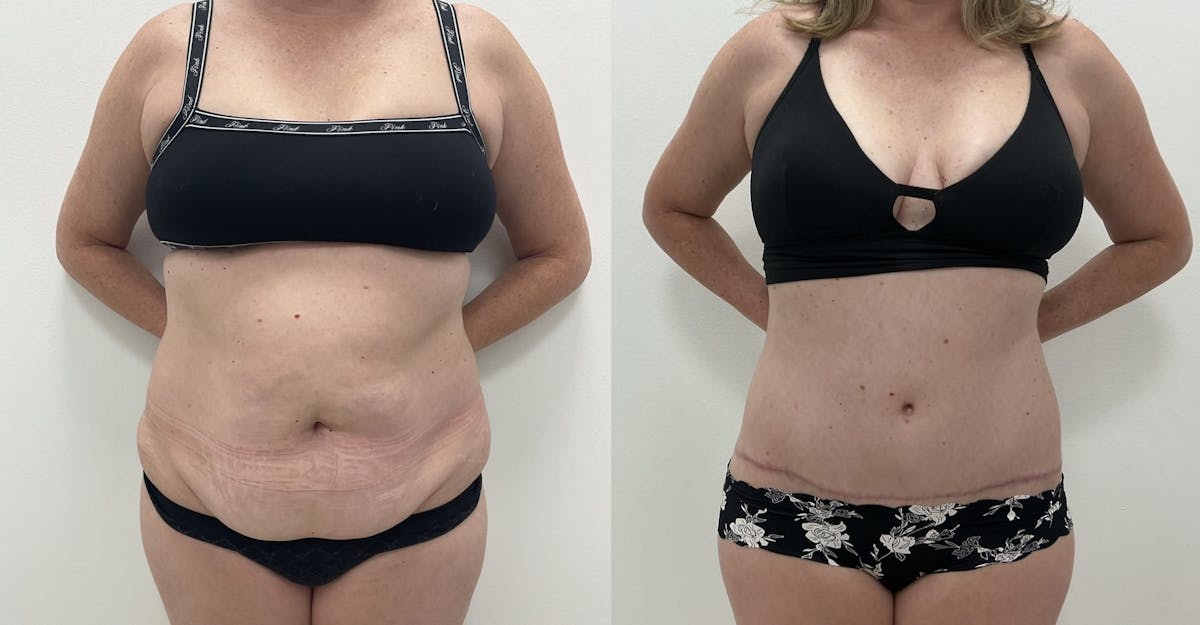 Tummy Tuck Before & After Gallery - Patient 226731 - Image 1
