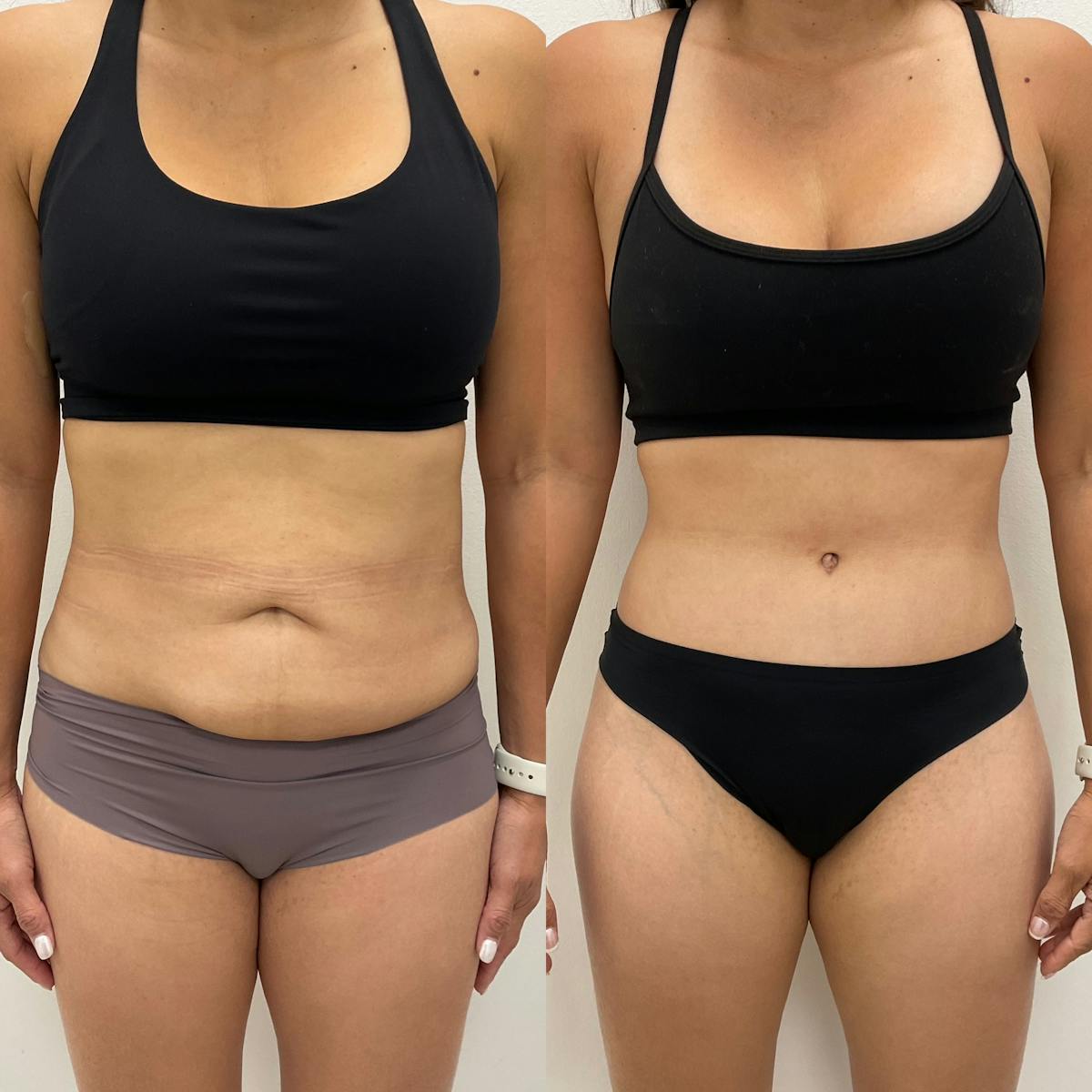 Tummy Tuck Before & After Gallery - Patient 321407 - Image 1