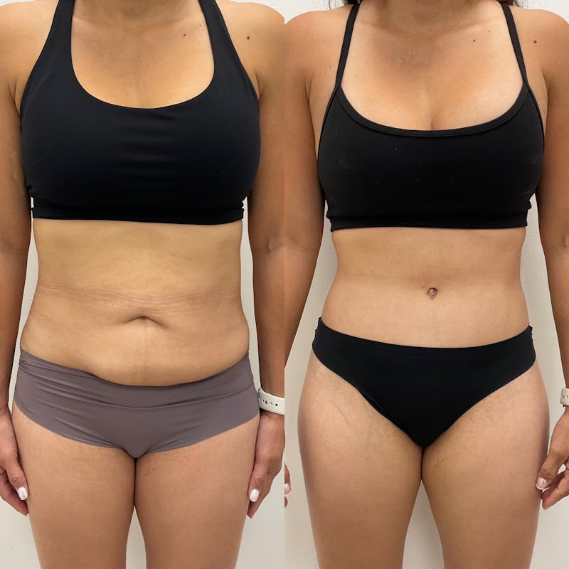 Tummy Tuck Before & After Gallery - Patient 321407 - Image 1