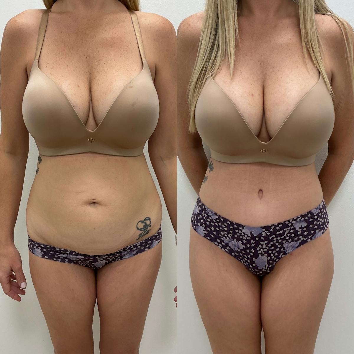 Tummy Tuck Before & After Gallery - Patient 363127 - Image 1