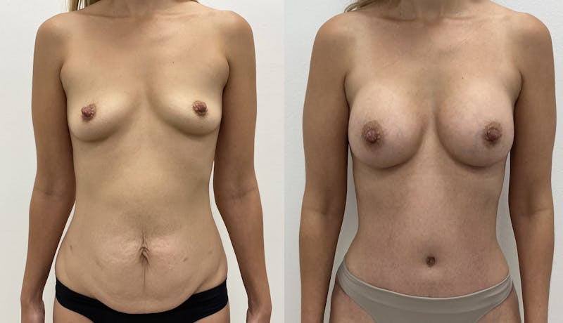 Tummy Tuck Before & After Gallery - Patient 110073 - Image 1