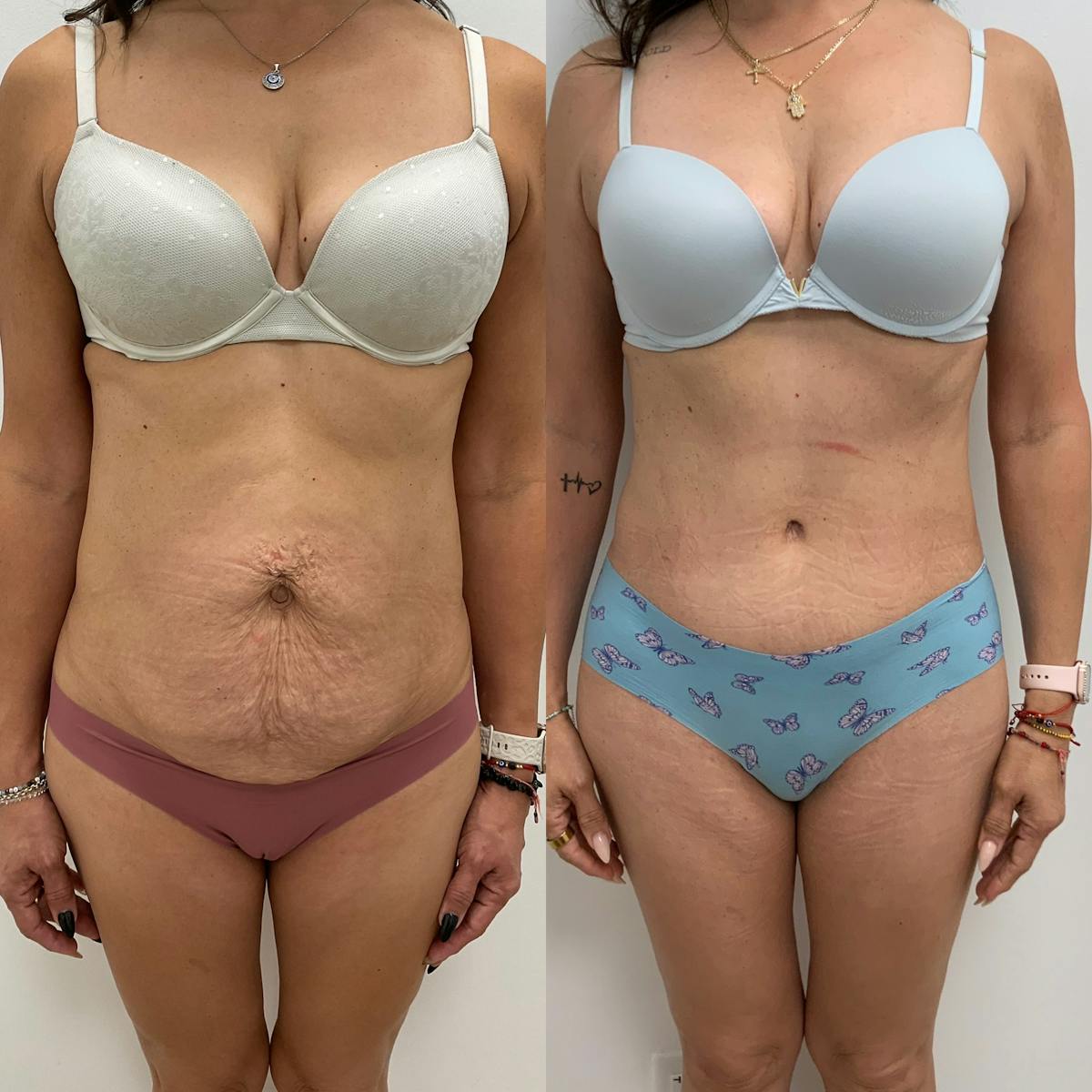 Tummy Tuck Before & After Gallery - Patient 121545 - Image 1