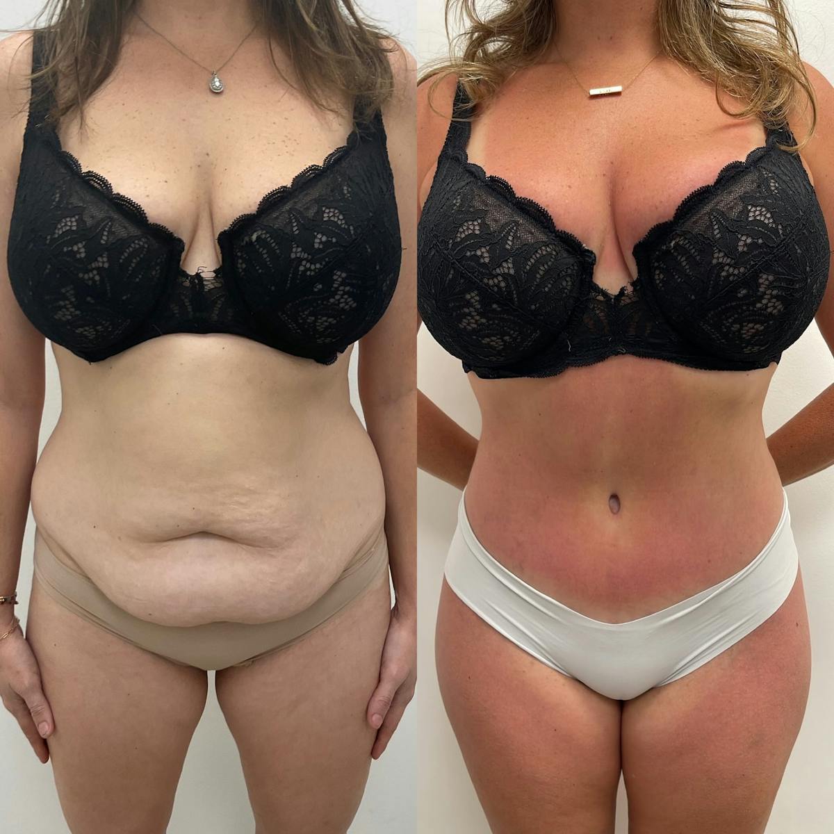 Tummy Tuck Before & After Gallery - Patient 378491 - Image 1