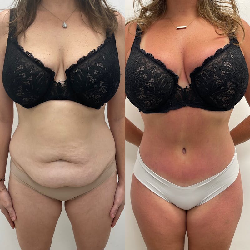 Tummy Tuck Before & After Gallery - Patient 378491 - Image 1