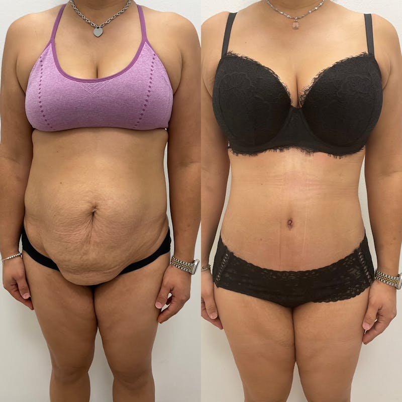 Tummy Tuck Before & After Gallery - Patient 815525 - Image 1