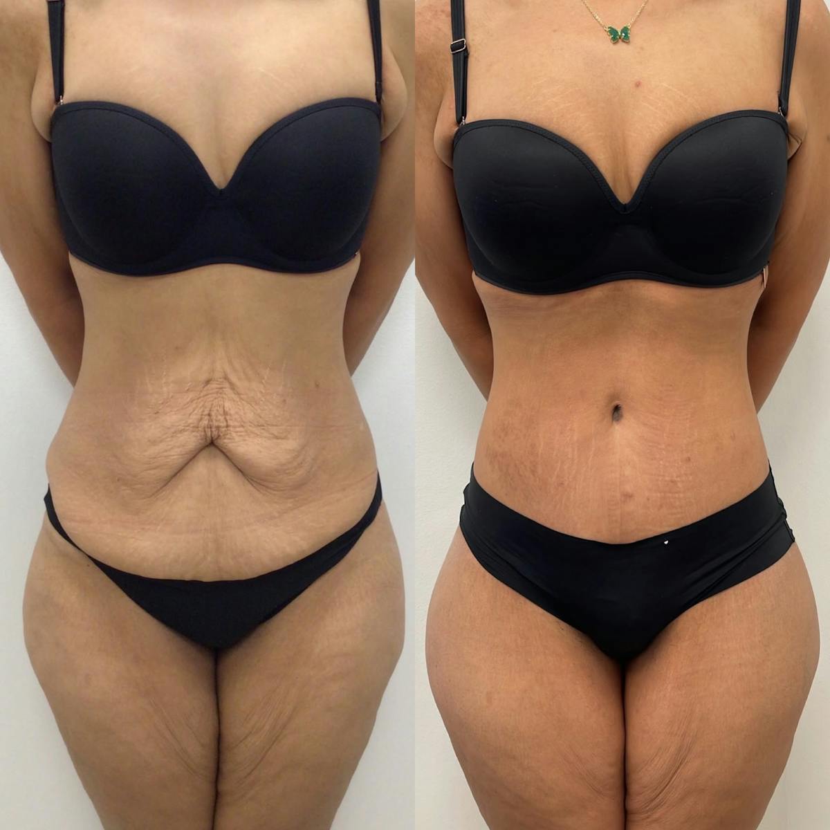 Tummy Tuck Before & After Gallery - Patient 236223 - Image 1
