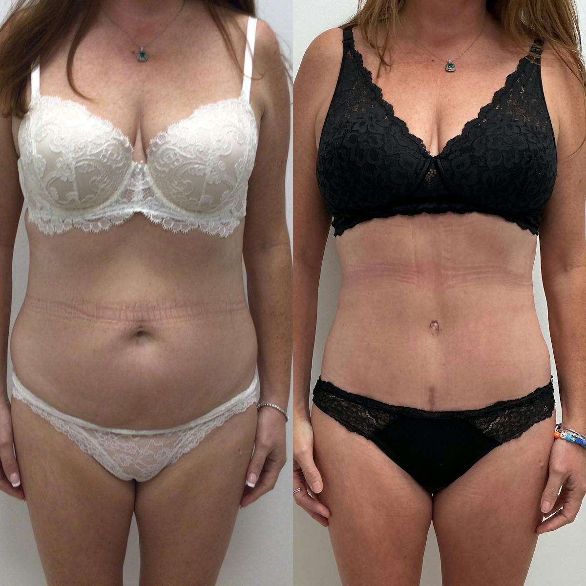 Tummy Tuck Before & After Gallery - Patient 347301 - Image 1