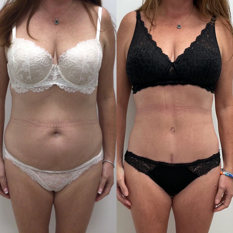 Tummy Tuck Before & After Gallery - Patient 347301 - Image 1