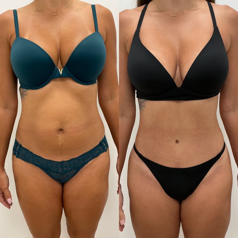 Tummy Tuck Before & After Gallery - Patient 280375 - Image 1