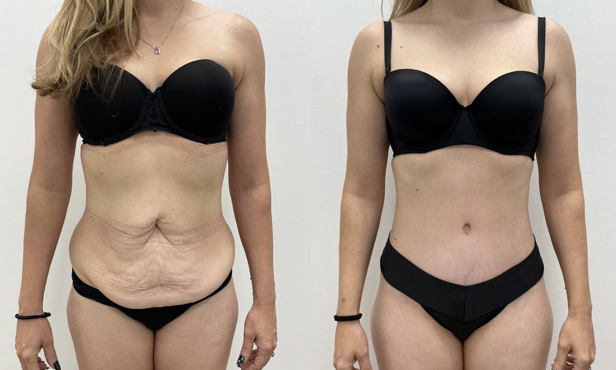 Tummy Tuck Before & After Gallery - Patient 403217 - Image 1
