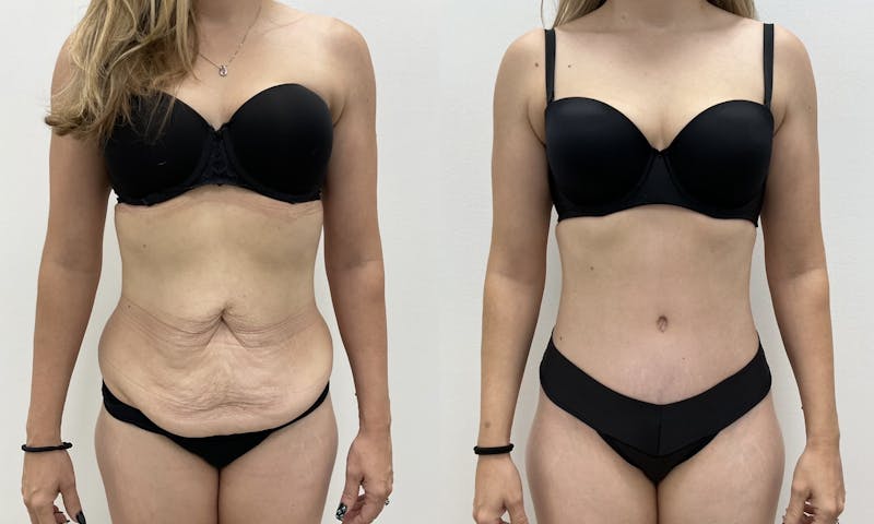 Tummy Tuck Before & After Gallery - Patient 403217 - Image 1