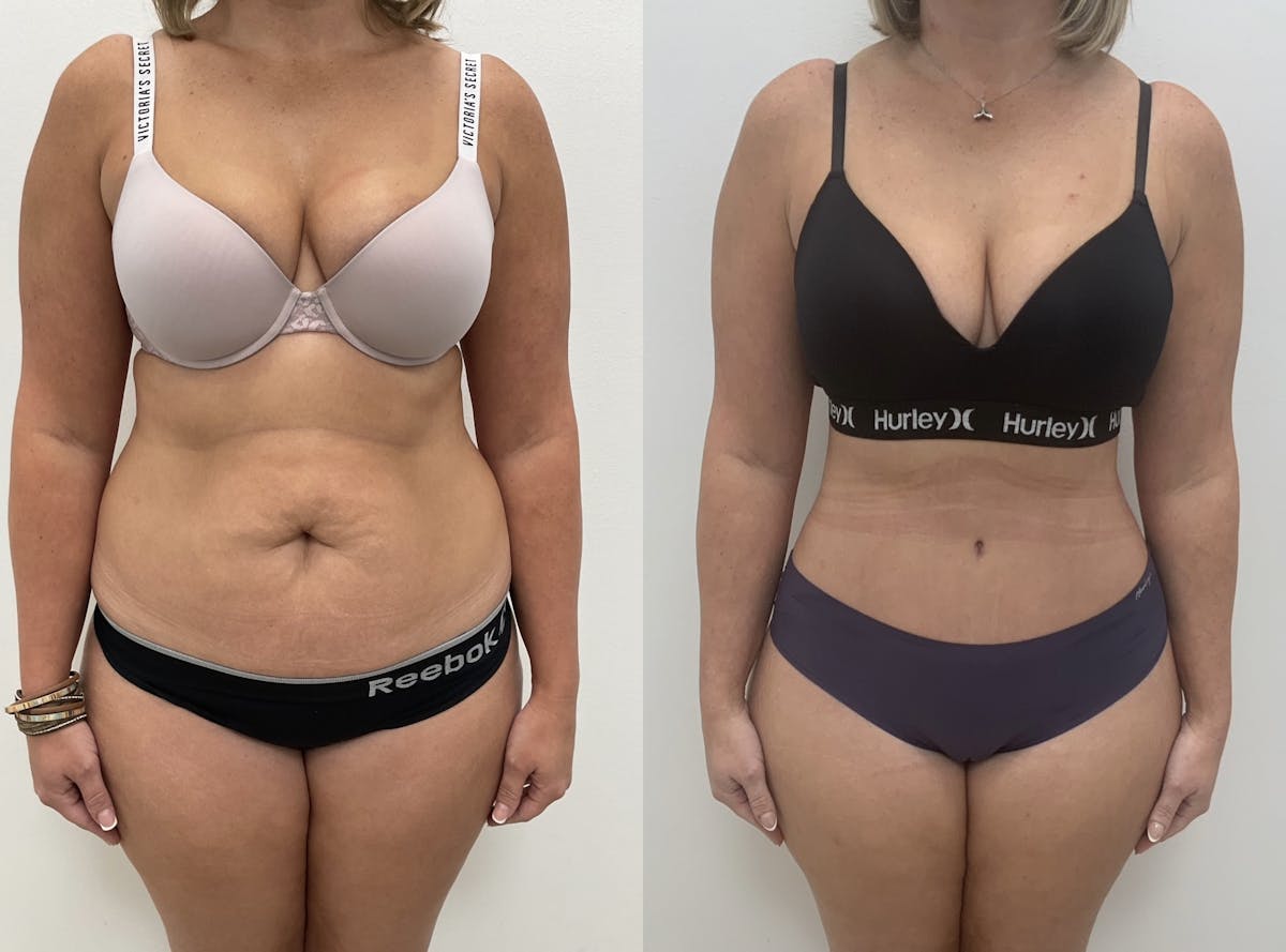 Tummy Tuck Before & After Gallery - Patient 353999 - Image 1