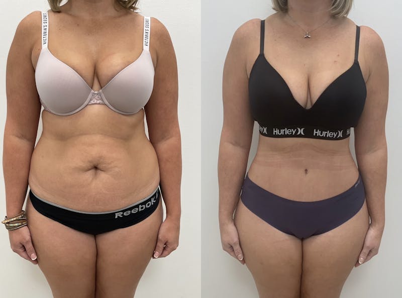 Tummy Tuck Before & After Gallery - Patient 353999 - Image 1