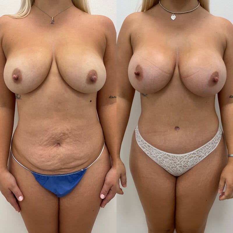 Tummy Tuck Before & After Gallery - Patient 249475 - Image 1