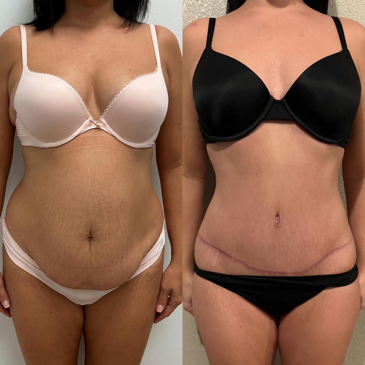 Tummy Tuck Before & After Gallery - Patient 269657 - Image 1