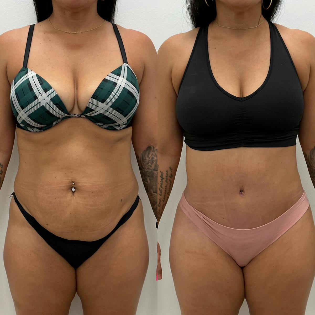 Tummy Tuck Before & After Gallery - Patient 236449 - Image 1