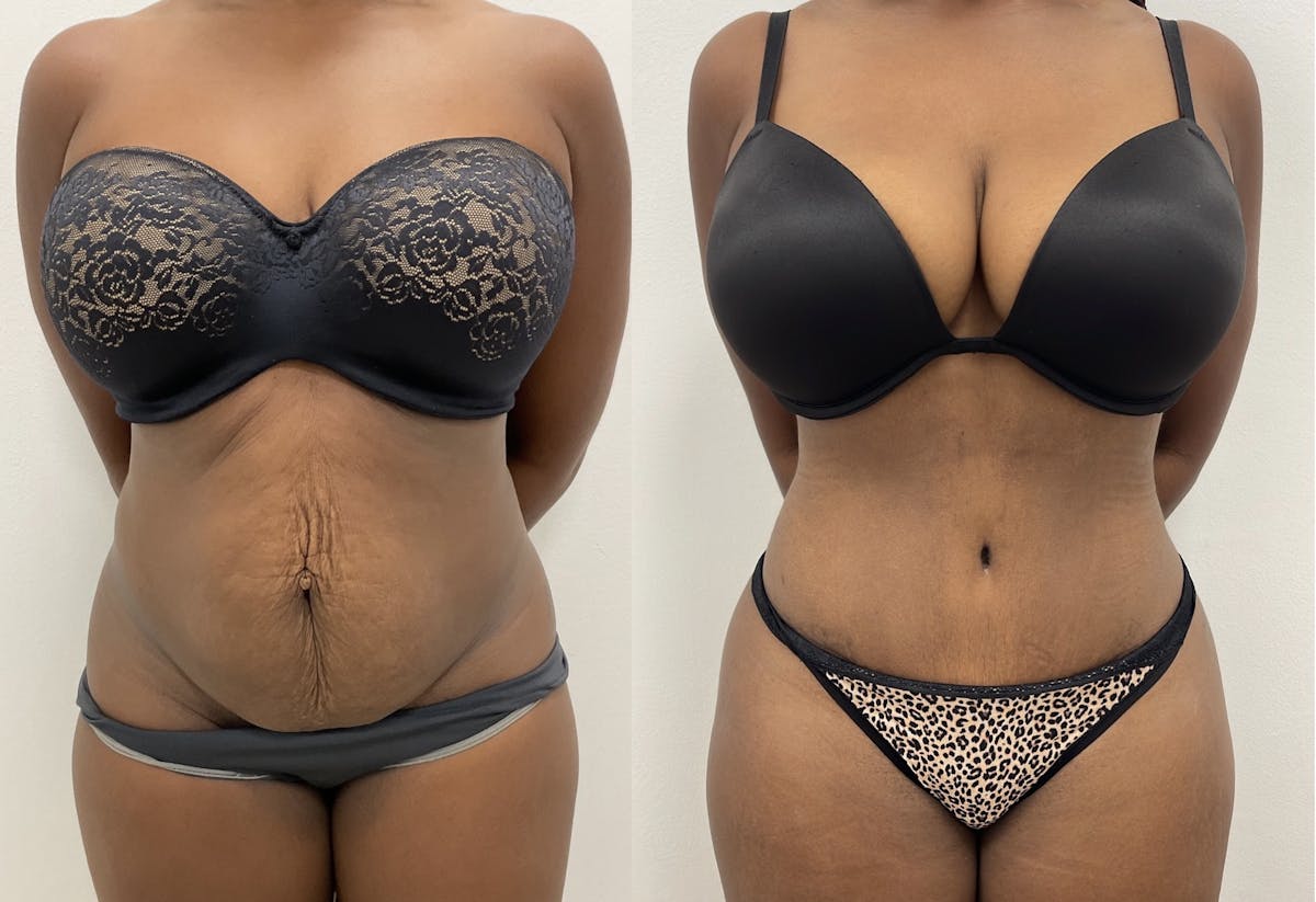 Tummy Tuck Before & After Gallery - Patient 334157 - Image 1