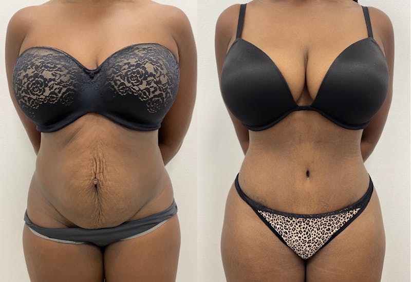 Tummy Tuck Before & After Gallery - Patient 334157 - Image 1