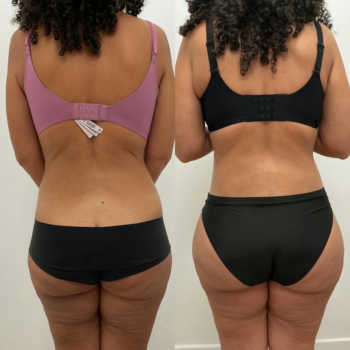 Tummy Tuck Before & After Gallery - Patient 214205 - Image 1